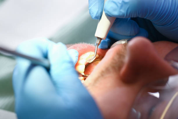 Best Emergency Dentist for Knocked-Out Tooth in Washington, DC